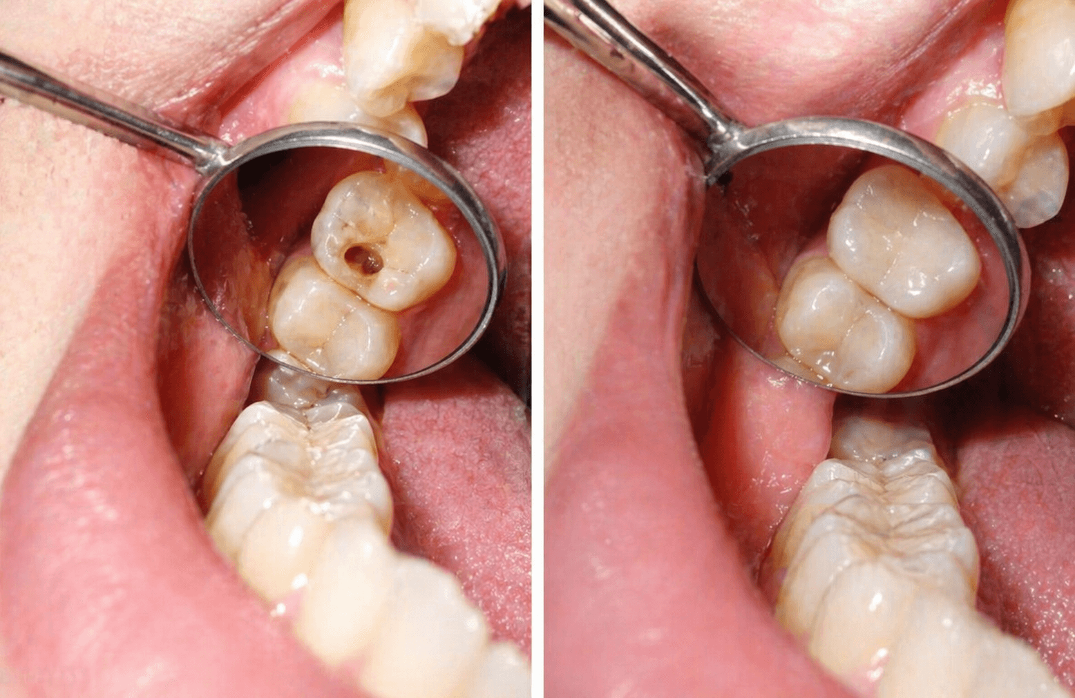 Dental Fillings